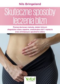 Skuteczne sposoby leczenia blizn - Nils Bringeland - ebook