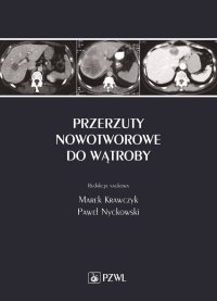 Przerzuty nowotworowe do wątroby - Marek Krawczyk - ebook