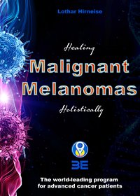 Malignant Melanomas - Lothar Hirneise - ebook