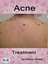 Acne Treatment - Owen Jones - ebook