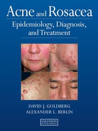 Acne and Rosacea [DRM] - Alexander Berlin - ebook