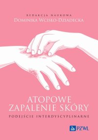 Atopowe zapalenie skóry. Podejście interdyscyplinarne - Dominika Wcisło-Dziadecka - ebook